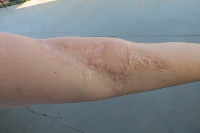 acidente na infancia segurança do trabalho